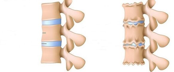 una columna vertebral sana y osteocondrosis