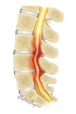 Con la osteocondrosis de la columna torácica, se produce una compresión del canal espinal. 