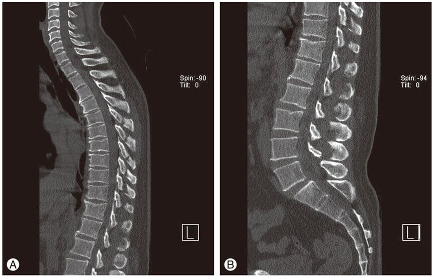 Deformación de los discos intervertebrales en imágenes de resonancia magnética en la osteocondrosis torácica
