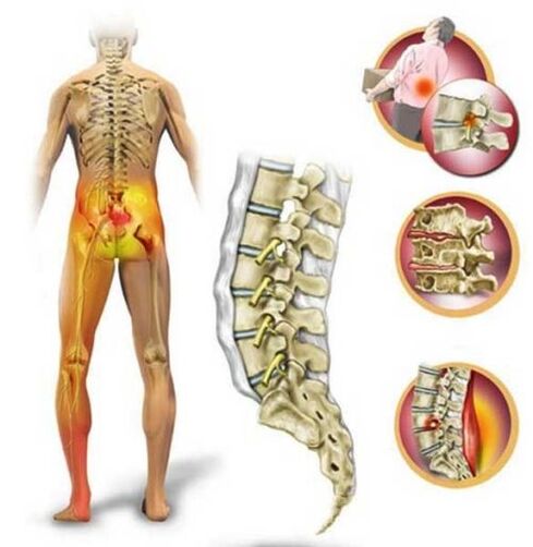 Osteocondrosis de la columna lumbar, que causa dolor de espalda. 