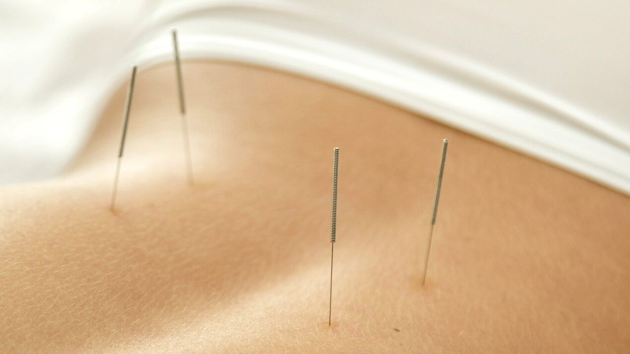 La acupuntura ayudará a eliminar el dolor lumbar