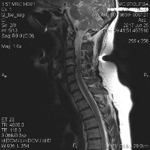 La osteocondrosis y la espondilosis en la región cervical de la columna vertebral